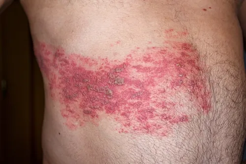 Culebrilla: Una enfermedad silenciosa que puede sorprender a los mayores de 50